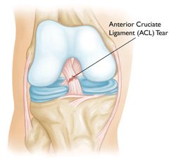 Diagram drawing of a torn ACL.