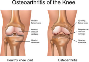 Diagram describing the differences between a healthy knee joint and an osteoarthritic knee. A healthy knee joint will have a healthy femur bone, healthy articular cartilage, and a healthy tibia bone. On the other hand, osteoarthritis of the knee will cause spurring on the femur bone, degeneration of the articular cartilage, and spurring on the tibia bone.