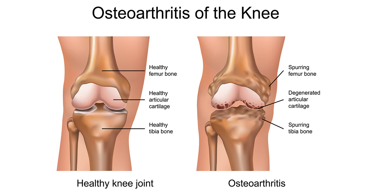 osteoarthritis of the knee