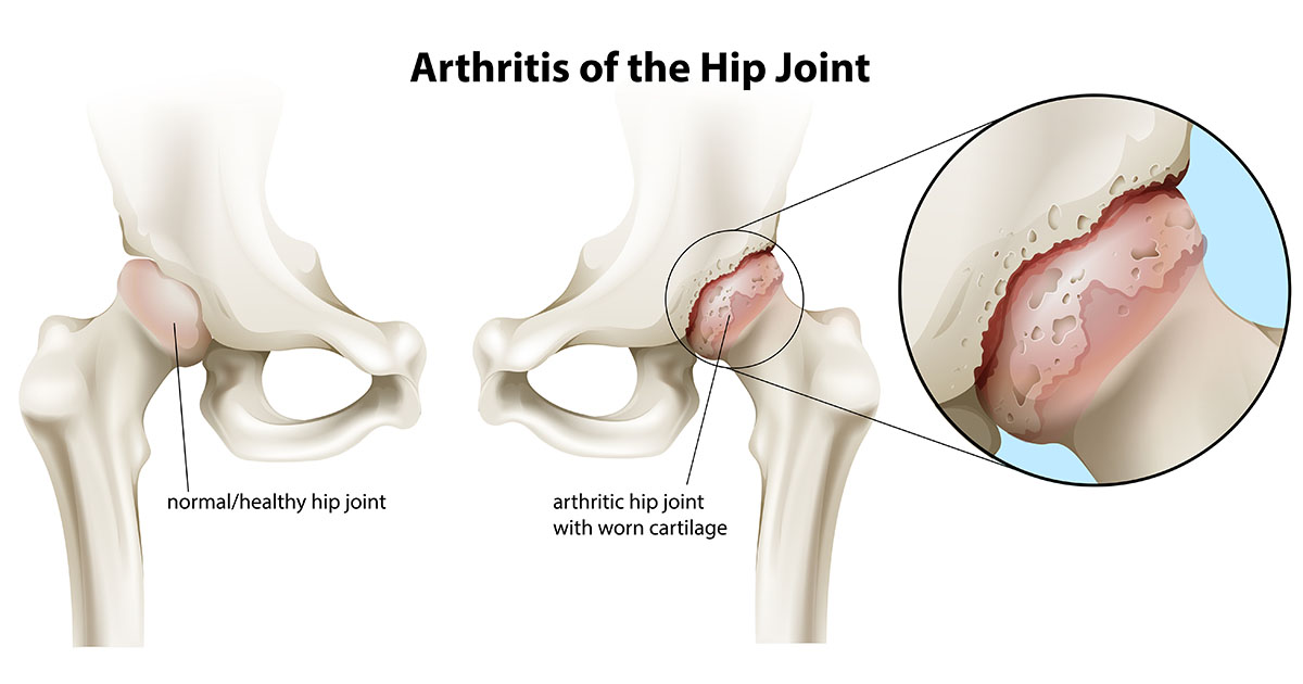 arthritis of the hip joint