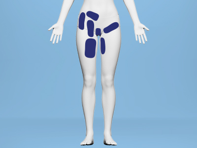 Front hip pain
