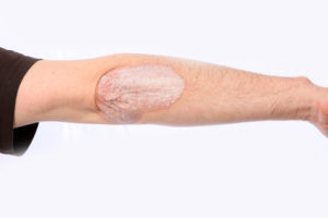 psoriasis on an elbow