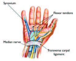 carpal tunnel syndrome