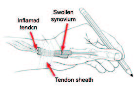 de Quervain's tendinosis