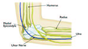 cubital tunnel syndrome