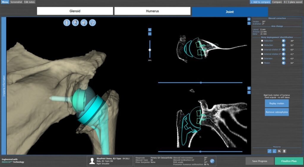 Image of 3D Planning Technology used for Shoulder Surgeries.